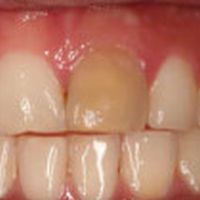A discolored front tooth