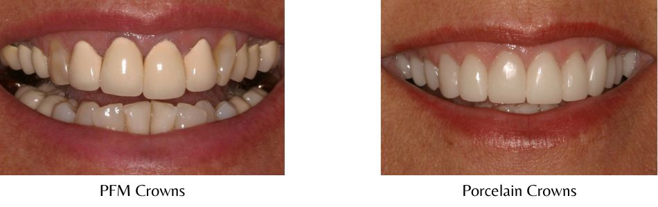 Side-by-side photos showing the aesthetic difference between porcelain crowns and porcelain-fused-to-metal crowns.
