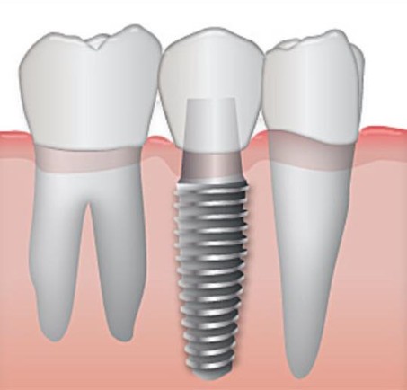 A diagram showing how dental implants consist of a crown attached to an implanted screw, mimicking the structure of a natural tooth.