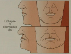 Drawing of a woman's face - both profile and front - before and after facial collapse, showing how the cheeks have sunk and the chin has puckered. Receiving implant-supported dentures can prevent this condition.