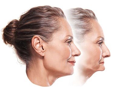 A rendering of a woman's face before and after experiencing facial collapse. In the after image, her cheeks and jaw are sunken, and her face is shriveled.
