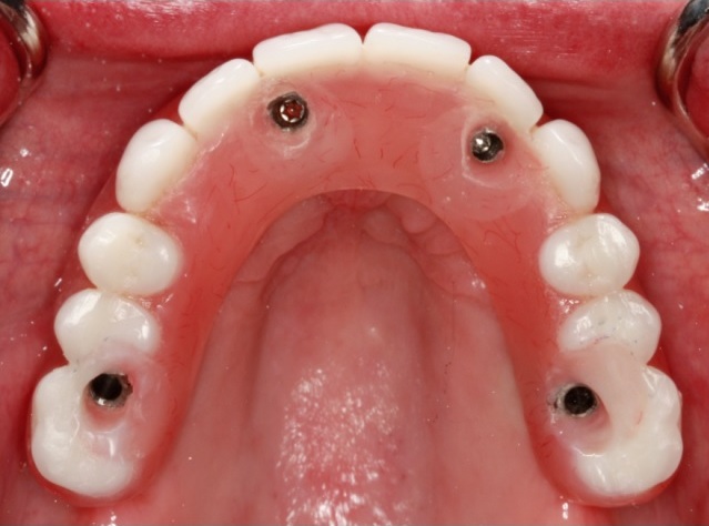Photo of a set of fixed implant dentures firmly secured to the upper jaw.