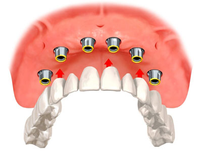 Diagram of an implant bridge in which a full set of teeth is being replaced using six crowns on six implants, with the remaining artificial teeth between and behind.