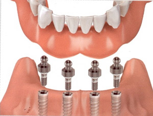 A rendering of a lower set of implant-supported dentures that shows how the denture attaches to the snaps, which are secured to the implant fixtures.