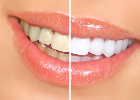 Split photo comparing a woman's smile before and after a teeth whitening smile makeover.