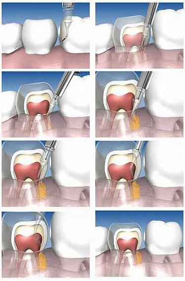 A series of drawings that depict a form of periodontal treatment.