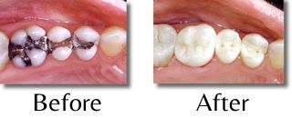 Side-by-side photos showing a holistic patient's teeth before and after sanitary amalgam removal by a dentist.