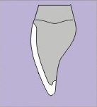 Diagram of a porcelain veneer - not one of the no-prep Lumineers - that is flush against a tooth, showing the thin margin of enamel that had to be removed.