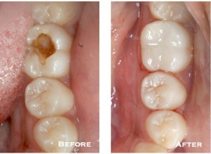 Side-by-side photos showing a molar before and after receiving a metal-free composite filling.