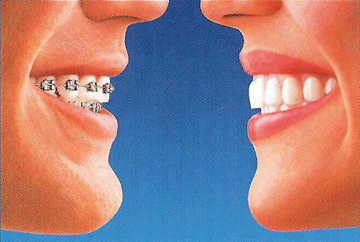 Drawing of two smiles facing each other: one on the left with traditional braces and one on the right with an Invisalign aligner.