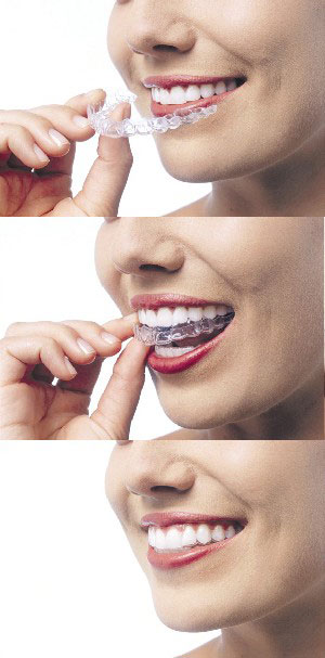 Three photos layered vertically to depict the simple process of inserting an Invisalign aligner.
