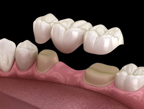 3D rendering of a metal-free bridge being placed over teeth and gums.