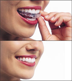 Top and bottom photos showing a woman both as she is placing an Invisalign aligner and after it has been placed.