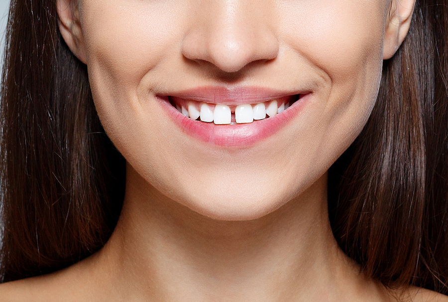 Close-up of a woman's smile that reveals a gap between her two front teeth. 