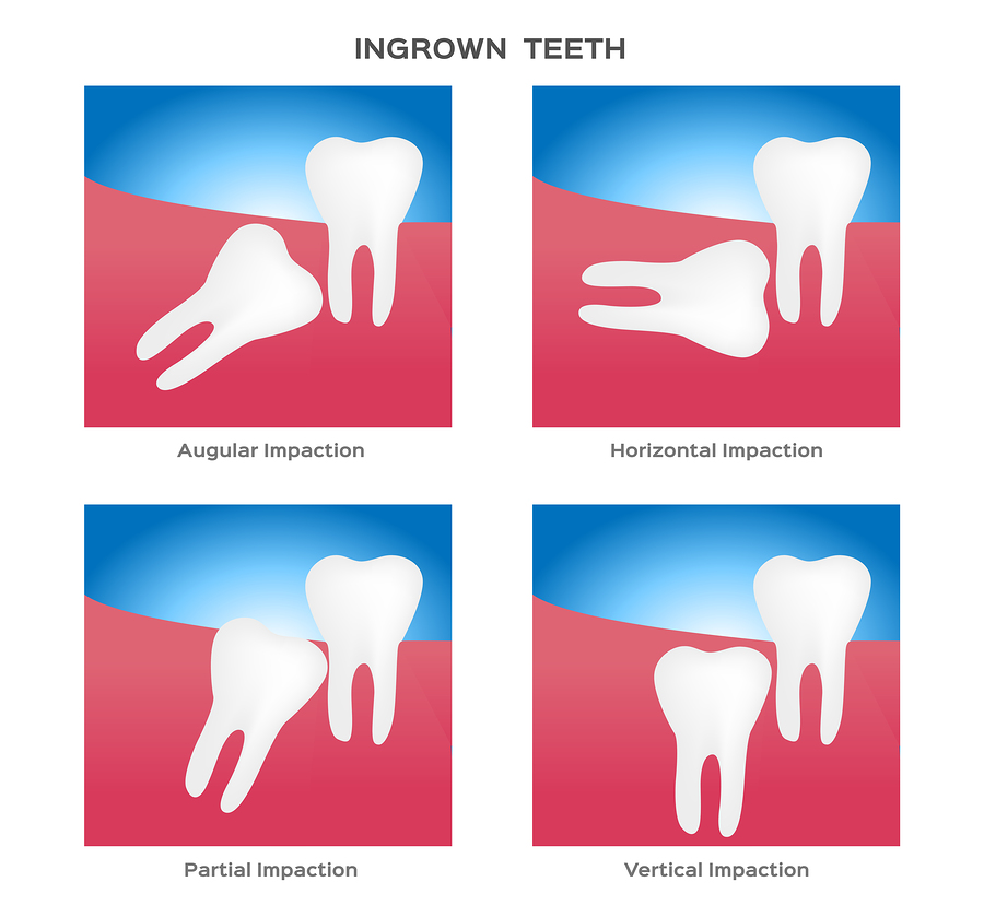 Diagram showing four types of wisdom teeth impaction.
