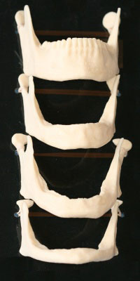 A series of jawbone models showing how facial collapse occurs as a result of the process of bone resorption over time.
