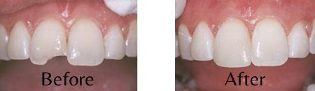 Side-by-side photos of a patient's upper teeth both before and after composite bonding was used to correct a front tooth chip.