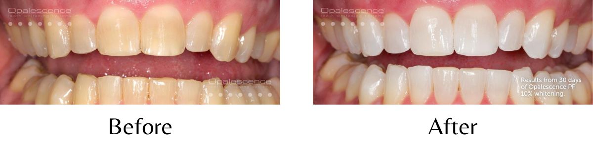 Side-by-side photos of a patient's smile before and after Opalescence teeth whitening.