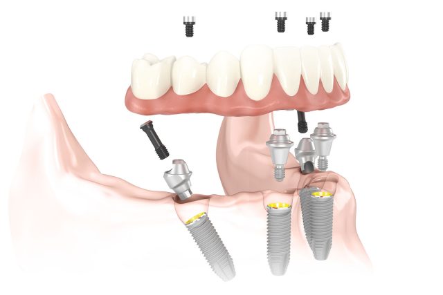 Rendering of a lower denture being attached to the jaw via four angled implants using the All-on-4 technique.