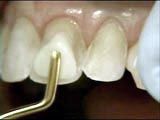 A tooth is prepared before composite bonding material is applied.