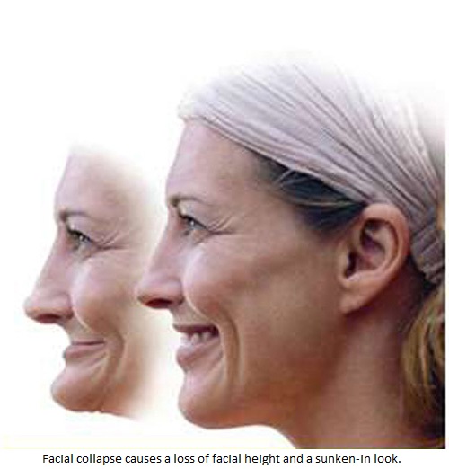 Digital imaging showing how a woman's face would be shriveled by the condition of facial collapse.