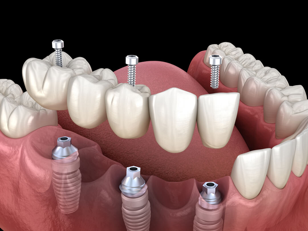 Rendering of a ceramic bridge being securely attached to the lower jaw via three dental implants.