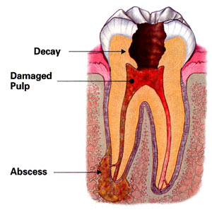 Diagram of the inside of a tooth that needs root canal treatment. The decay, damaged pulp, and abscess are labeled.