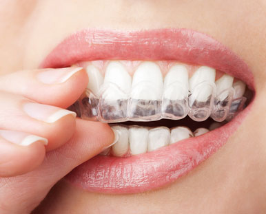 Close-up of a woman inserting a teeth whitening tray into her mouth.