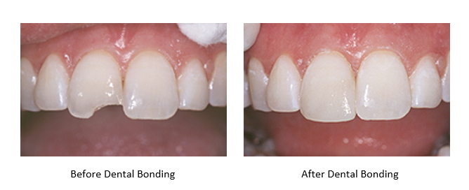 A side by side image of teeth before and after dental bonding.