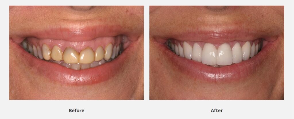 Before and after image of tetracycline stains covered by porcelain veneers