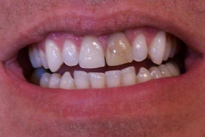 A discolored front tooth