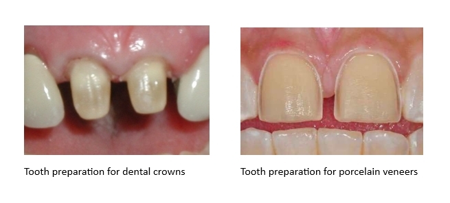 A comparison of dental crown preparation versus porcelain veneers preparation